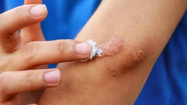 Thu hồi, tiêu huỷ 1 loại gel 'ngừa sẹo' do vi phạm 3 lỗi